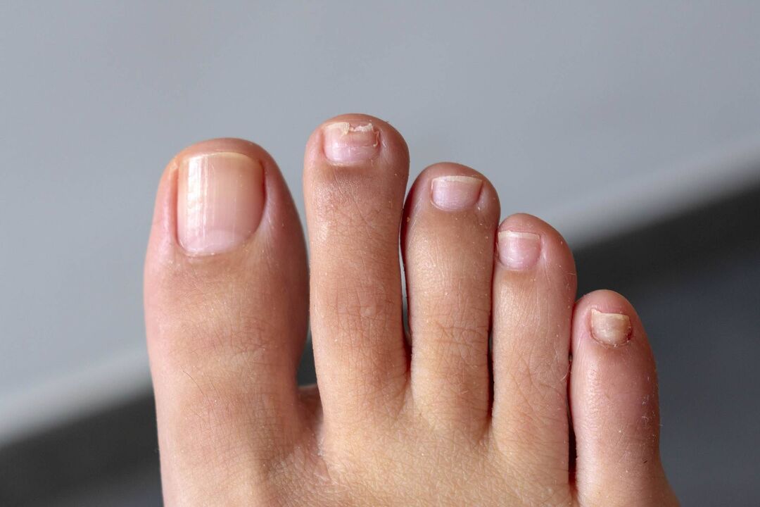 symptômes de mycose des ongles des pieds